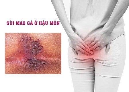 Tổng quan từ A- Z bệnh sùi mào gà ở hậu môn