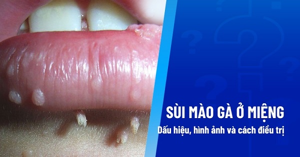 Cảnh báo sùi mào gà ở miệng lưỡi: Nhận biết sớm – Điều trị đúng cách trước khi quá muộn