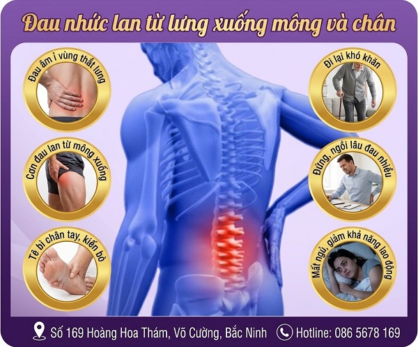 Đau nhức lan từ lưng xuống mông và chân – 7 nguyên nhân phổ biến bạn cần biết