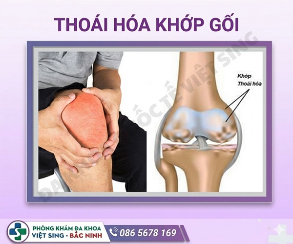 Thoái hóa khớp gối: Nhận biết sớm để hạn chế biến chứng