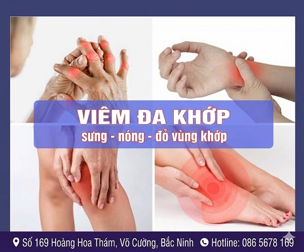 https://dakhoabacninh.com/wp-content/uploads/2026/05/viem-da-khop.jpeg
