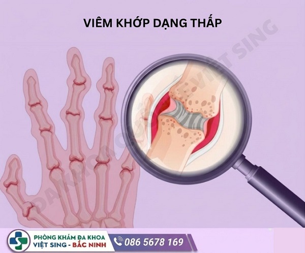 Viêm khớp dạng thấp: Đừng để đau nhức kéo dài thành biến dạng khớp