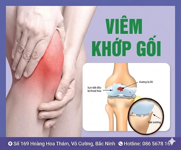 https://dakhoabacninh.com/wp-content/uploads/2026/05/viem-khop-goi.jpeg